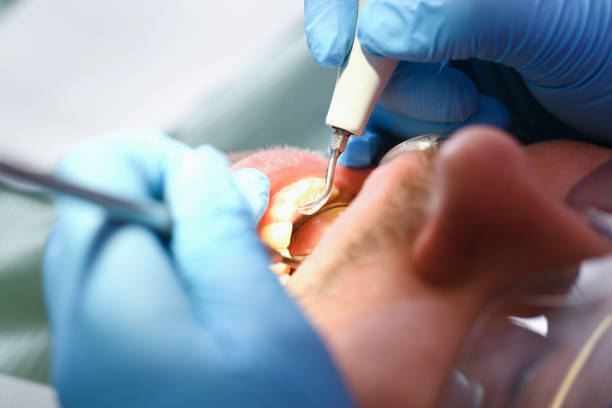 Best Emergency Broken Tooth Repair in Hornell, NY
